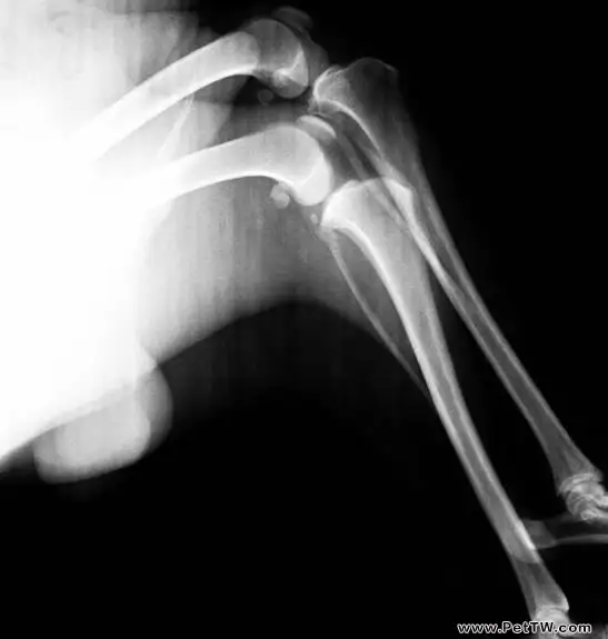 外固定支架在四肢骨骨折中的應用