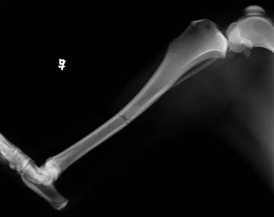 外固定支架在四肢骨骨折中的應用