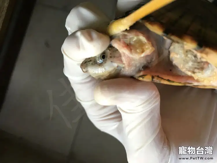 一例剃刀龜頸部腫瘤的切除報告